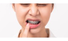 Hệ lụy của niềng răng sai cách và cách khắc phục