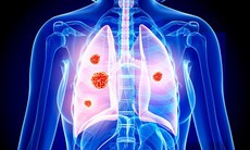 Cứ 5 người mắc ung thư phổi trên thế giới, có 3 ca thuộc khu vực Châu Á: Đâu là lý do?