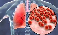 Nấm phổi: Nguyên nhân, dấu hiệu và cách phòng ngừa
