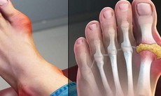 Những yếu tố nào gây nên các cơn đau dữ dội đối với người bệnh gout?