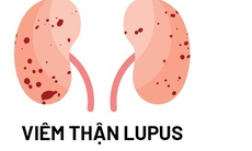 Bước ngoặt mới cho bệnh nhân viêm thận lupus