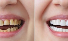 Nên chọn phương pháp bọc răng sứ nào?
