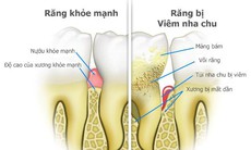 Vệ sinh răng miệng tốt giúp bảo vệ não khỏi chứng mất trí nhớ