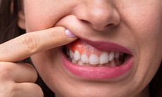 Biểu hiện viêm lợi và cách phòng ngừa hiệu quả