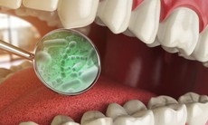 Vi khuẩn trong miệng ảnh hưởng thế nào đến sức khỏe?