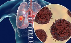 Bệnh nhân ung thư phổi giai đoạn 4 có thể được chữa khỏi bằng liệu pháp miễn dịch?