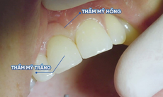 Các yếu tố quyết định đến tính thẩm mỹ khi trồng răng implant