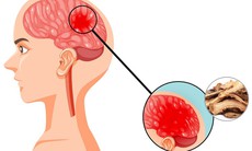 5 vị thuốc trị thiếu máu não, cách sử dụng và lưu ý khi dùng