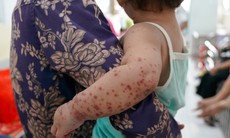 TP.HCM: Trừ điểm địa phương có ca tử vong do sốt xuất huyết, tay chân miệng