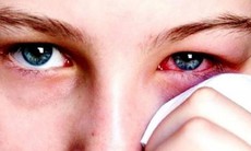 Đau mắt đỏ quay trở lại sau khi vắng bóng trong dịch COVID-19, cần lưu ý gì?