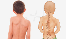 Vẹo cột sống ở trẻ nguyên nhân, biểu hiện và các biện pháp phòng ngừa