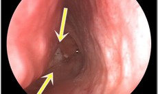 Mũi chảy mủ hôi, người đàn ông mắc nấm xoang hàm lan tỏa