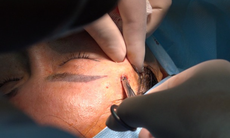 Tiêm filler ở cơ sở "chui", một phụ nữ suýt bị mù mắt