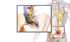 5 biện pháp giảm triệu chứng viêm cột sống dính khớp