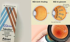 Mù một bên mắt vì dùng thuốc nhỏ mắt kéo dài