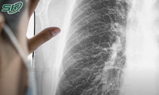 Phát hiện ung thư phổi cực hiếm gặp chỉ sau vài tuần tức ngực