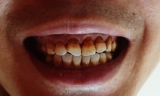 6 bệnh răng miệng do hút thuốc gây ra ít người biết