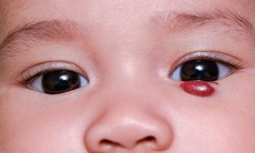 U máu vùng hàm mặt ở trẻ có cần điều trị?
