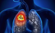 Chuyên gia kêu gọi thay đổi xét nghiệm ung thư phổi trên khắp Châu Á để giải quyết sự đa dạng di truyền