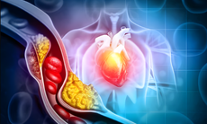 6 cách giúp giảm cholesterol có thể làm ngay tại nhà