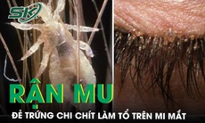 Kinh hãi rận mu chi chít, đẻ trứng làm tổ trên mi mắt người phụ nữ