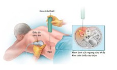 Khi nào phải sinh thiết thận?