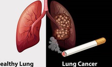 Chồng hút thuốc lá vợ lại mắc ung thư phổi, chuyên gia ung thư nói gì?