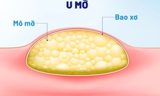 U mỡ có nguy hiểm không?