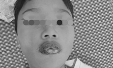 Tự mua thuốc chữa ho cho con, bé 11 tuổi bị loét môi miệng, diễn biến nặng