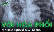 Xẹp phổi, vôi hoá màng phổi - Di chứng nặng nề của lao phổi
