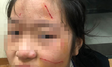 Nữ sinh lớp 6 bị bạn đánh, 'dùng dao rọc giấy rạch lên mặt', nhà trường nói gì?