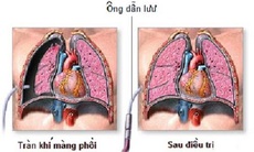 Tràn khí màng phổi ở những người hút thuốc lá