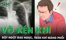 Đau ngực đột ngột, khó thở phát hiện tràn khí màng phổi, vỡ kén khí