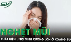 Nghẹt mũi, nhức đầu, cô gái trẻ bất ngờ mắc u mũi xoang