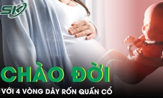 Bé trai chào đời với 4 vòng dây rốn quấn cổ