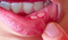 Làm gì khi trẻ bị viêm loét miệng?