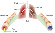 Những triệu chứng viêm phế quản cấp cần lưu ý