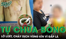 Bé 2 tuổi lở loét chảy dịch vùng kín vì bố mẹ tự đắp lá chữa bỏng tại nhà