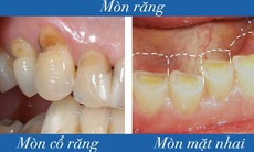 Mòn răng: Nguyên nhân, triệu chứng, cách điều trị và phòng bệnh