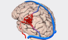 Chế độ ăn cho người bệnh dị dạng mạch não