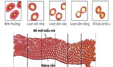 Loạn sản cổ tử cung: Nguyên nhân, triệu chứng, cách điều trị và phòng ngừa