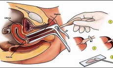 Thuốc và các phương pháp điều trị bệnh loạn sản cổ tử cung