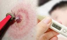 Babesia: Nguyên nhân, biểu hiện, cách điều trị và phòng bệnh