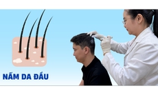 Câu hỏi thường gặp liên quan đến nấm da đầu