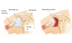 Viêm chóp xoay: Nguyên nhân, triệu chứng, cách điều trị và các biện pháp phòng ngừa