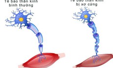 Thuốc điều trị bệnh xơ cột bên teo cơ