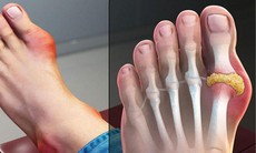 Điều trị bệnh gout cần lưu ý 3 điều sau