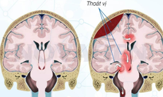 Thoát vị não: Nguyên nhân, triệu chứng, chẩn đoán và điều trị