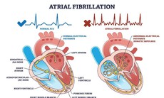 Rối loạn nhịp tim: tìm hiểu những rủi ro tiềm ẩn