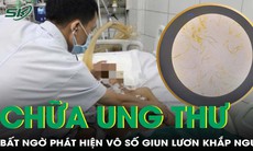 Bệnh nhân ung thư suy kiệt, xét nghiệm phát hiện vô số giun lươn trong người